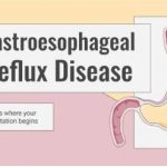 The Ultimate Guide to Treating Gastroesophageal Reflux Disease (GERD) and Creating an Engaging PPT Presentation